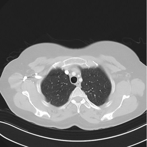 Cerebral abscess from pulmonary arteriovenous malformation (Radiopaedia 86275-102292 Axial lung window 15).png