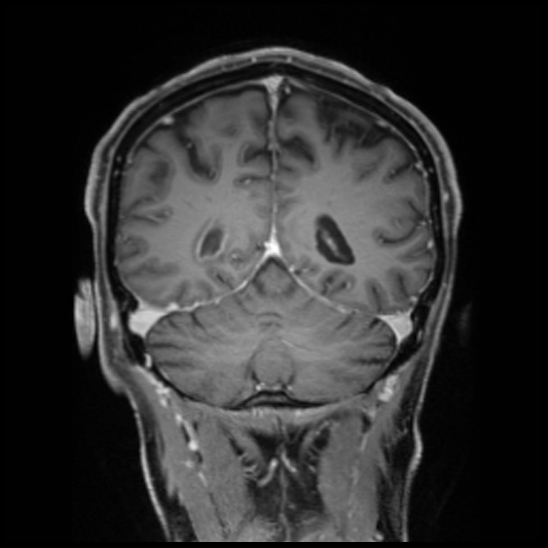 Cerebral abscess with ventriculitis (Radiopaedia 78965-91878 Coronal T1 C+ 46).jpg