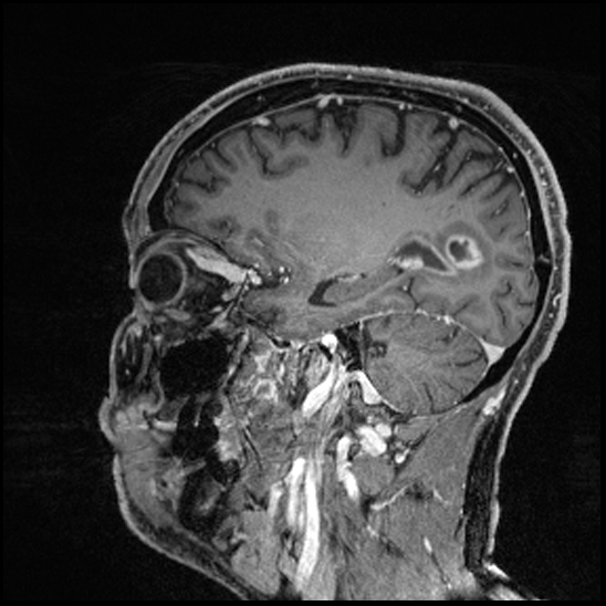 Cerebral abscess with ventriculitis (Radiopaedia 78965-91878 Sagittal T1 C+ 60).jpg