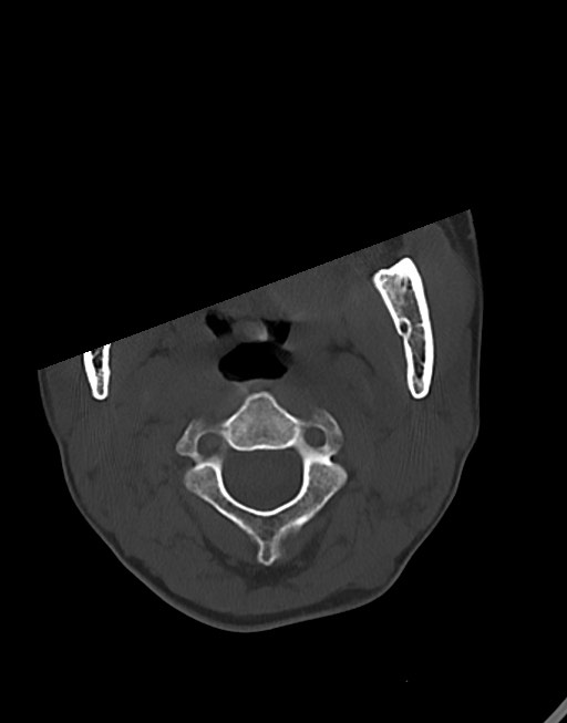 Cerebral abscesses (Radiopaedia 70458-80568 Axial bone window 1).jpg