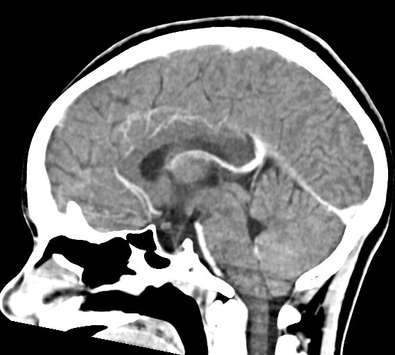 Cerebral abscesses (Radiopaedia 70458-80568 Sagittal Contrast 30).jpg