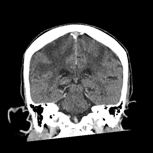 Cerebral amyloid angiopathy-related inflammation (Radiopaedia 74836-85848 Coronal non-contrast 44).jpg