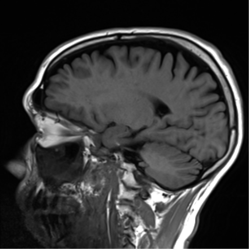 File:Cerebral amyloid angiopathy (Radiopaedia 46082-50433 Sagittal T1 18).png