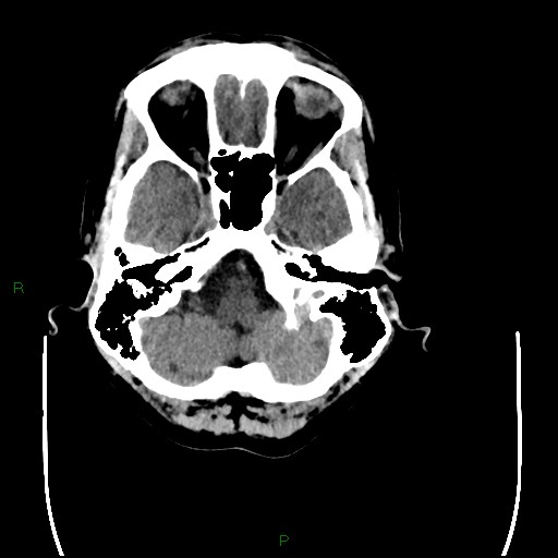 Cerebral amyloid angiopathy (Radiopaedia 77506-89665 Axial non-contrast 20).jpg