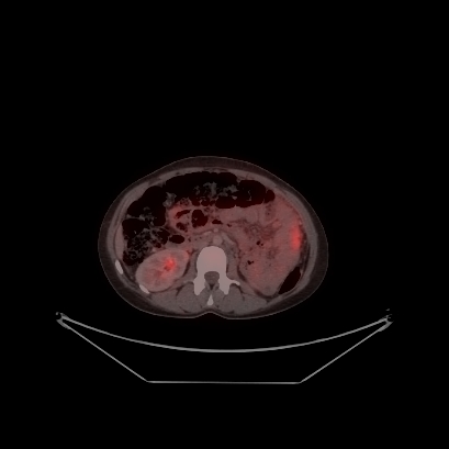 Cerebral and abdominal tuberculosis (Radiopaedia 90499-107853 C 164).jpg