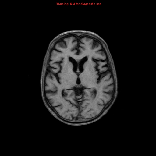 File:Cerebral and orbital tuberculomas (Radiopaedia 13308-13311 Axial T1 11).jpg