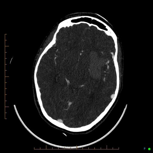 Cerebral arteriovenous malformation (AVM) (Radiopaedia 78162-90706 Axial CTA 131).jpg