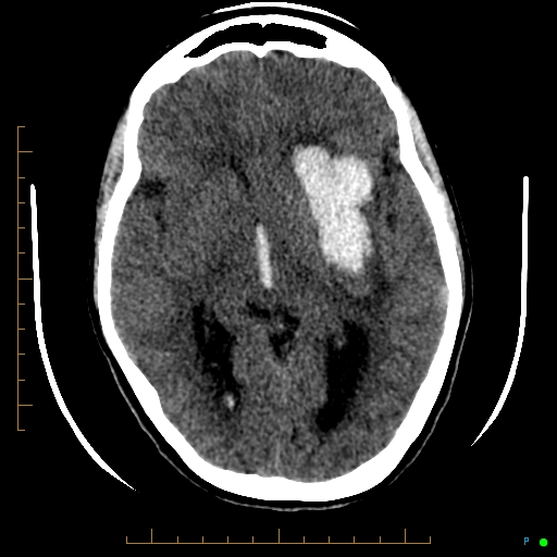 Cerebral arteriovenous malformation (AVM) (Radiopaedia 78162-90706 Axial non-contrast 31).jpg