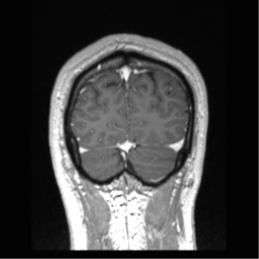 Cerebral arteriovenous malformation (Radiopaedia 39259-41506 Coronal T1 C+ 16).png