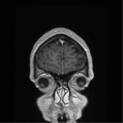 Cerebral arteriovenous malformation (Radiopaedia 39259-41506 Coronal T1 C+ 86).png