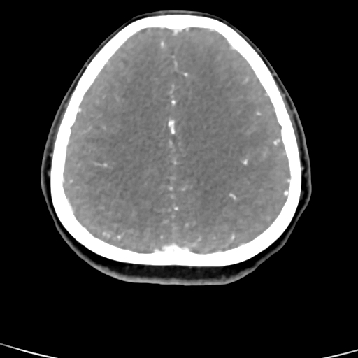 Cerebral arteriovenous malformation (Radiopaedia 73830-84645 B 29).jpg