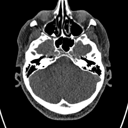 Cerebral arteriovenous malformation (Radiopaedia 78188-90746 Axial non-contrast 41).jpg