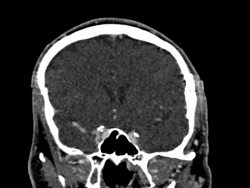 Cerebral arteriovenous malformation (Radiopaedia 78188-90746 Coronal C+ delayed 41).jpg