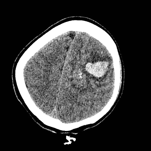 Cerebral arteriovenous malformation (Radiopaedia 79677-92887 Axial non-contrast 36).jpg