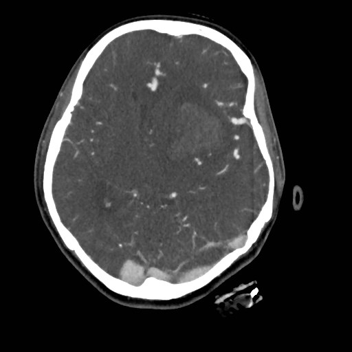 File:Cerebral arteriovenous malformation (Radiopaedia 79677-92888 A 24).jpg
