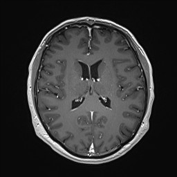 Cerebral arteriovenous malformation (Radiopaedia 84015-99245 Axial T1 C+ 91).jpg