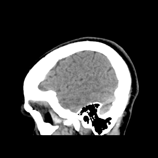 Cerebral arteriovenous malformation (Spetzler-Martin grade 2) (Radiopaedia 41262-44076 A 51).png