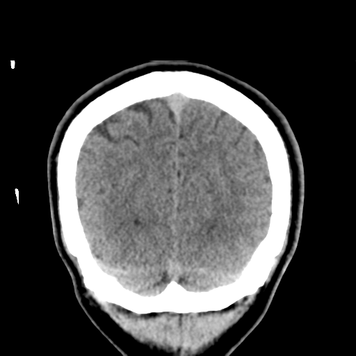 Cerebral arteriovenous malformation (Spetzler-Martin grade 2) (Radiopaedia 41262-44076 Coronal non-contrast 55).png