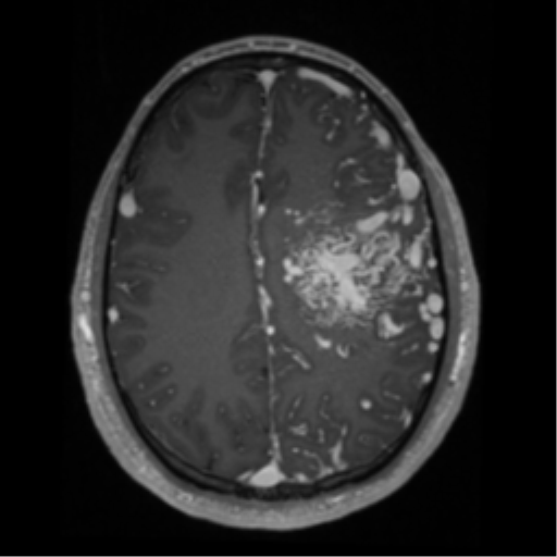 File:Cerebral arteriovenous malformation - huge (Radiopaedia 35734-37272 Axial T1 C+ 50).png