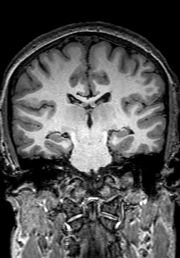 Cerebral arteriovenous malformation at posterior body of corpus callosum (Radiopaedia 74111-84925 Coronal T1 190).jpg