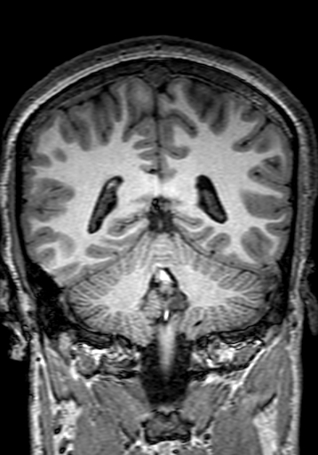 File:Cerebral arteriovenous malformation at posterior body of corpus callosum (Radiopaedia 74111-84925 Coronal T1 233).jpg