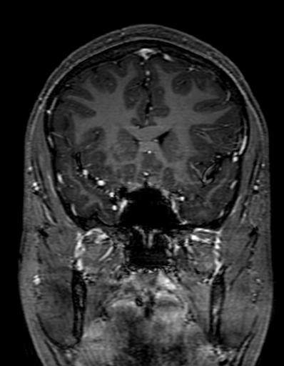Cerebral arteriovenous malformation at posterior body of corpus callosum (Radiopaedia 74111-84925 K 120).jpg