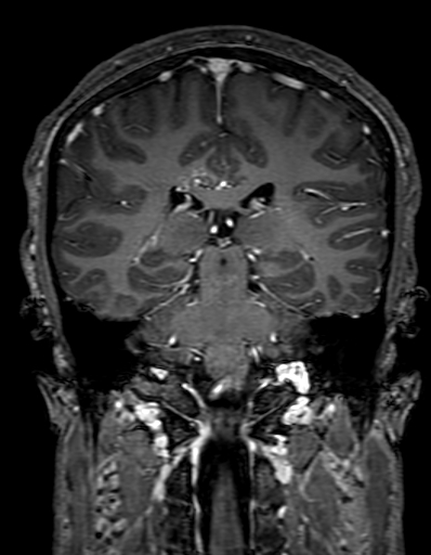 Cerebral arteriovenous malformation at posterior body of corpus callosum (Radiopaedia 74111-84925 K 225).jpg