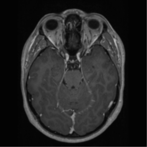 Cerebral cavernoma and development venous anomaly (Radiopaedia 37603-39482 Axial T1 C+ 28).png
