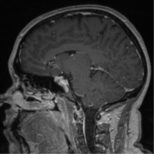 File:Cerebral cavernoma and development venous anomaly (Radiopaedia 37603-39482 Sagittal T1 C+ 44).png