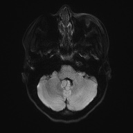 Cerebral cavernous venous malformation (Radiopaedia 70008-80021 Axial DWI 37).jpg