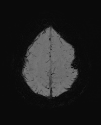 Cerebral cavernous venous malformation (Radiopaedia 70008-80021 Axial SWI 56).jpg