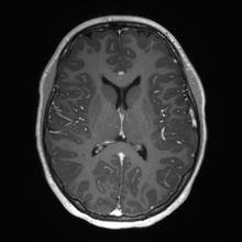 File:Cerebral cavernous venous malformation (Radiopaedia 70008-80021 Axial T1 C+ 40).jpg