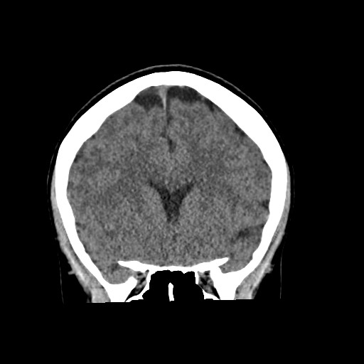 Cerebral cavernous venous malformation (Radiopaedia 70008-80022 non-contrast 26).jpg