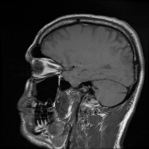 File:Cerebral cavernous venous malformation (Zabramski type II) (Radiopaedia 85511-101198 Sagittal T1 25).jpg