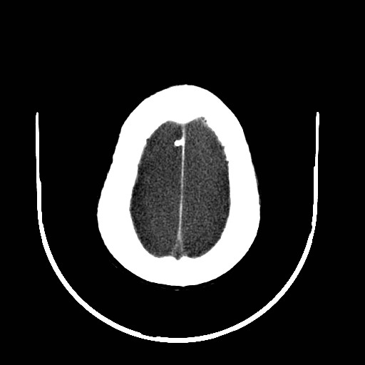 Cerebral edema (evolution in time) (Radiopaedia 19418-19439 non-contrast 81).jpg