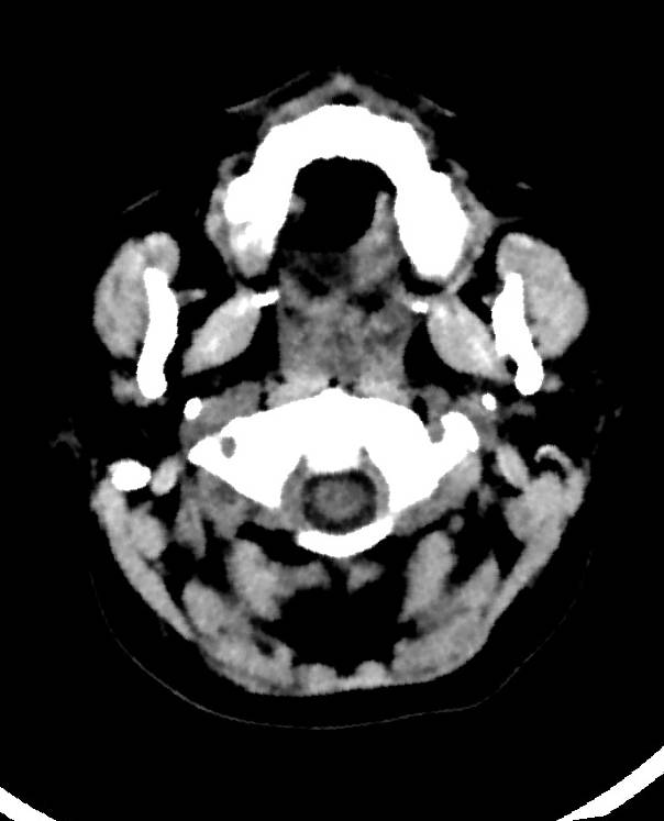 Cerebral edema due to severe hyponatremia (Radiopaedia 89826-106938 Axial non-contrast 6).jpg