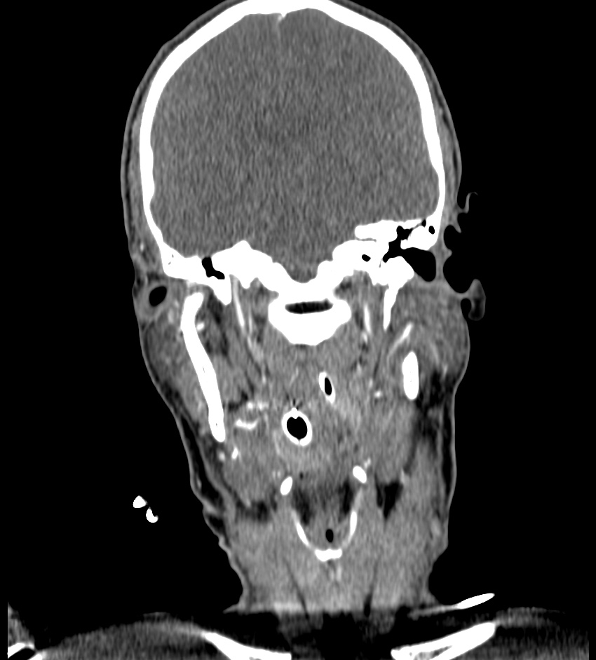 Cerebral edema in an overdose patient (Radiopaedia 72005-82539 B 60).jpg