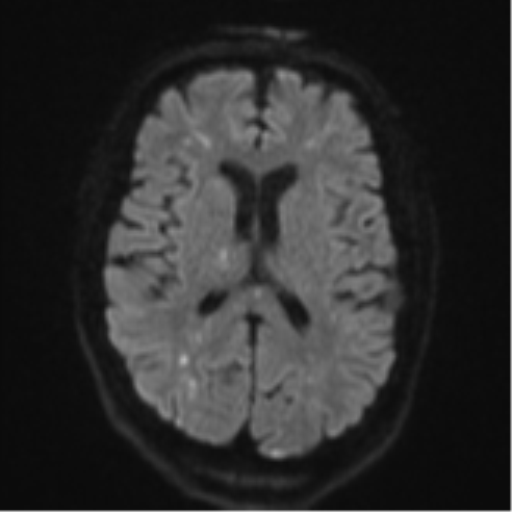 Cerebral embolic infarcts (embolic shower) (Radiopaedia 57395-64342 Axial DWI 57).png