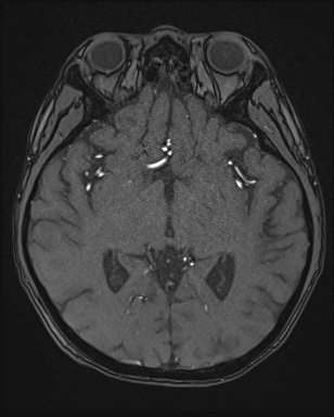 Cerebral embolic infarcts (embolic shower) (Radiopaedia 72391-82921 Axial MRA 78).jpg