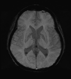 Cerebral embolic infarcts (embolic shower) (Radiopaedia 72391-82921 Axial SWI 38).jpg