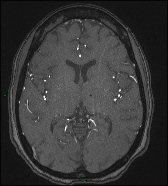Cerebral fat embolism (Radiopaedia 35022-36525 Axial TOF 107).jpg