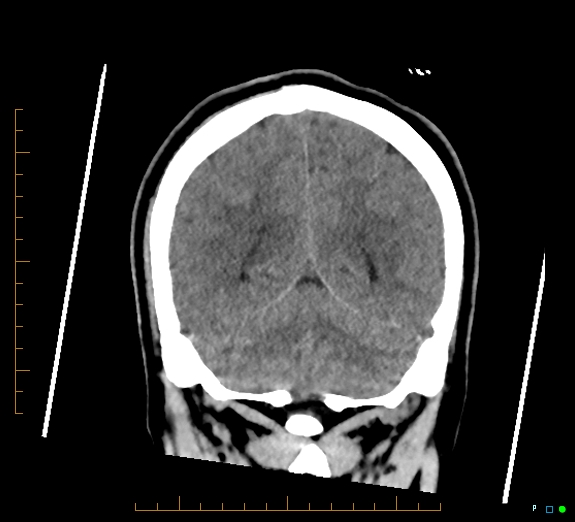 Cerebral fat embolism (Radiopaedia 85521-101220 Coronal non-contrast 46).jpg