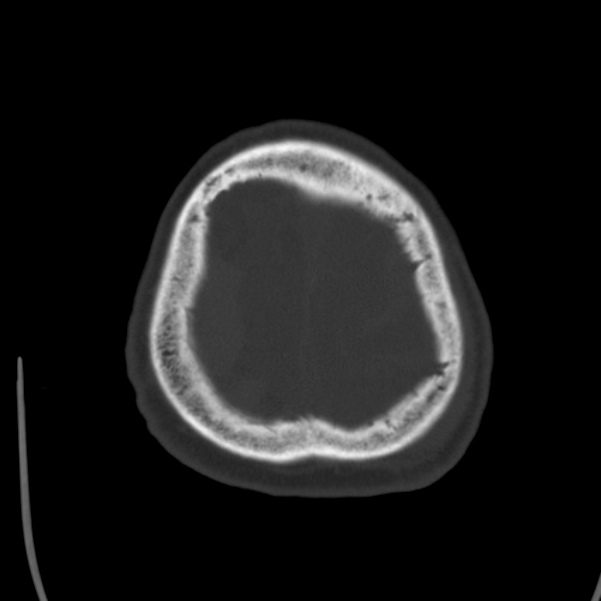 Cerebral hemorrhagic contusions (Radiopaedia 23145-23188 Axial bone window 51).jpg