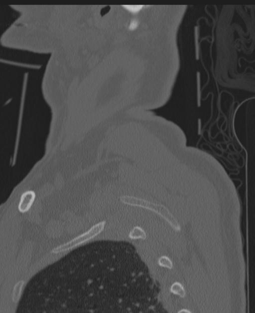 Cerebral hemorrhagic contusions and cervical spine fractures (Radiopaedia 32865-33841 Sagittal bone window 97).jpg