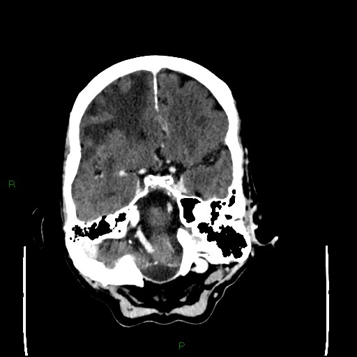 File:Cerebral metastases - breast primary (Radiopaedia 77653-89857 Axial C+ delayed 35).jpg