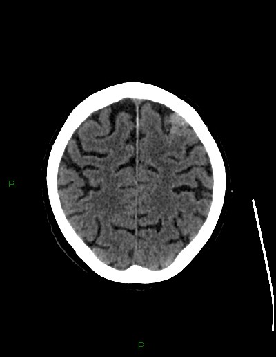 Cerebral metastases - ependymal and parenchymal (Radiopaedia 79877-93131 Axial non-contrast 61).jpg