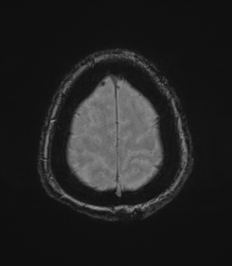 Cerebral metastasis to basal ganglia (Radiopaedia 81568-95413 Axial SWI magnitude 79).png