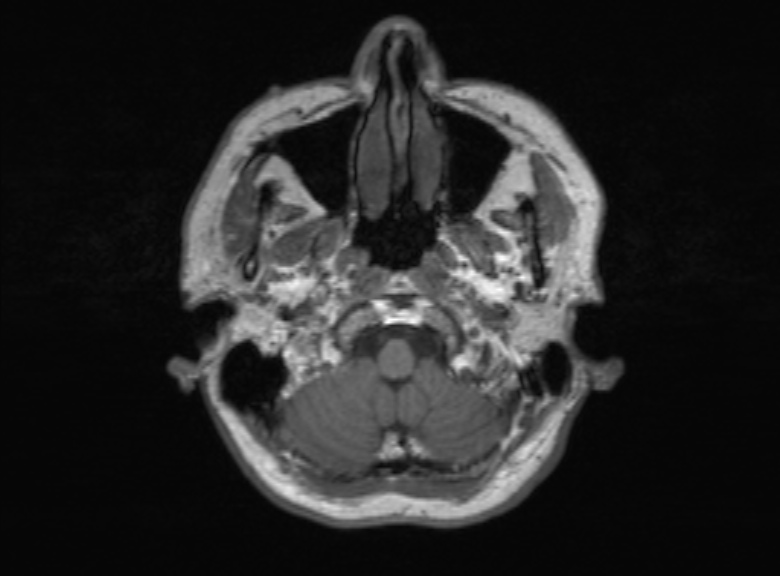 Cerebral ring enhancing lesions - cerebral metastases (Radiopaedia 44922-48817 Axial T1 344).jpg
