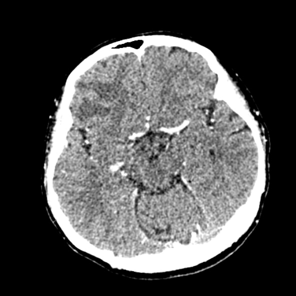 Cerebral ring enhancing lesions - cerebral metastases (Radiopaedia 44922-48818 B 117).jpg