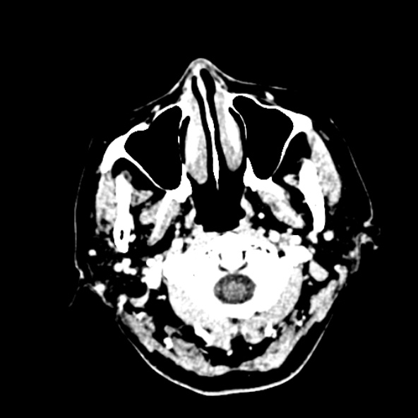 Cerebral ring enhancing lesions - cerebral metastases (Radiopaedia 44922-48818 B 2).jpg
